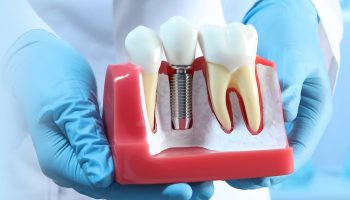 The Recovery Time for Dental Implants?