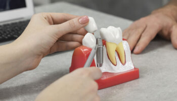 Dental Implants and Oral Health: Beyond Aesthetics