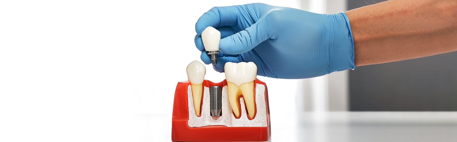 Are Dental Implants Worth It? Murfreesboro Experts Weigh In