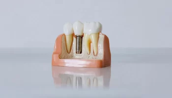 Are Dental Implants in Murfreesboro, TN, Right for You? Here’s How to Decide
