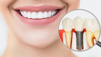 Are Dental Implants Right for You? Key Facts Every Murfreesboro Patient Should Know